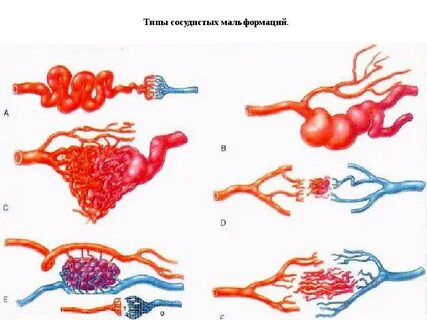 Венозная мальформация лечение