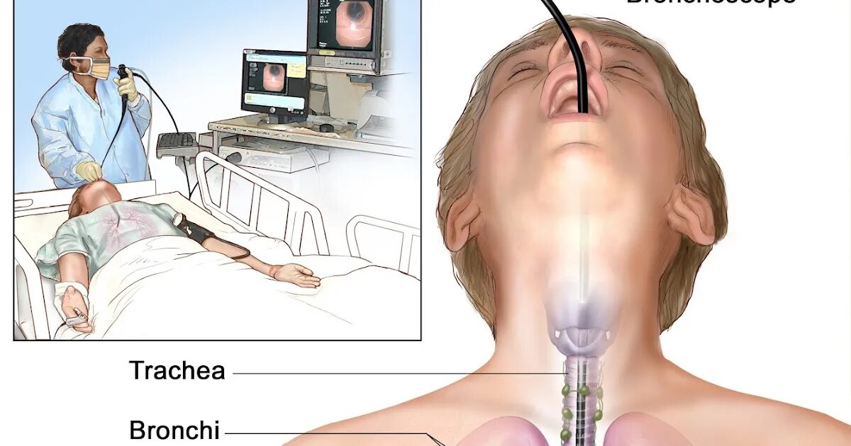 Бронхоскопия и бронхография. Санационная бронхоскопия. Ригидная бронхоскопия. Бронхоскопия опухоль трахеи. Где проверяют легкие