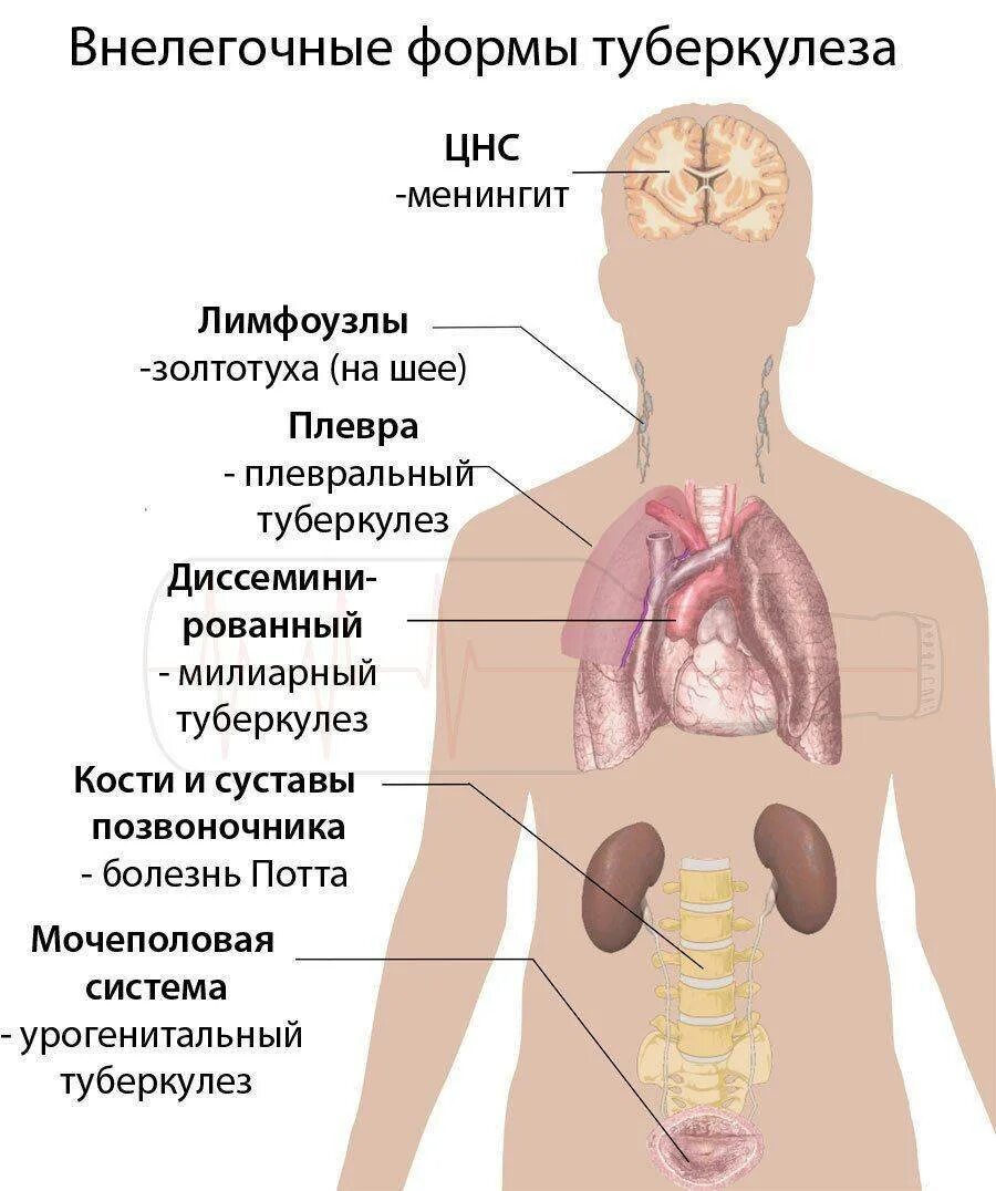 Поражаемые органы туберкулеза. Внелегочный туберкулез симптомы. Органный внелегочный туберкулез. Туберкулез внелегочной локализации. Внелегочные формы туберкулеза.