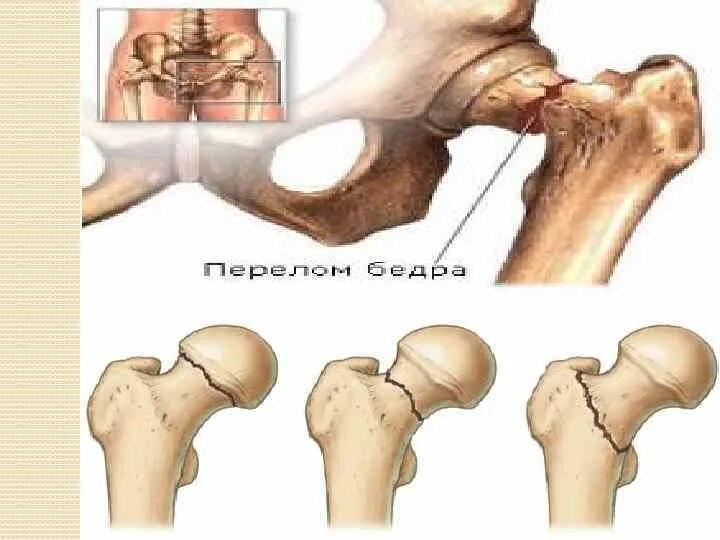 Симптомы шейка бедра у женщины