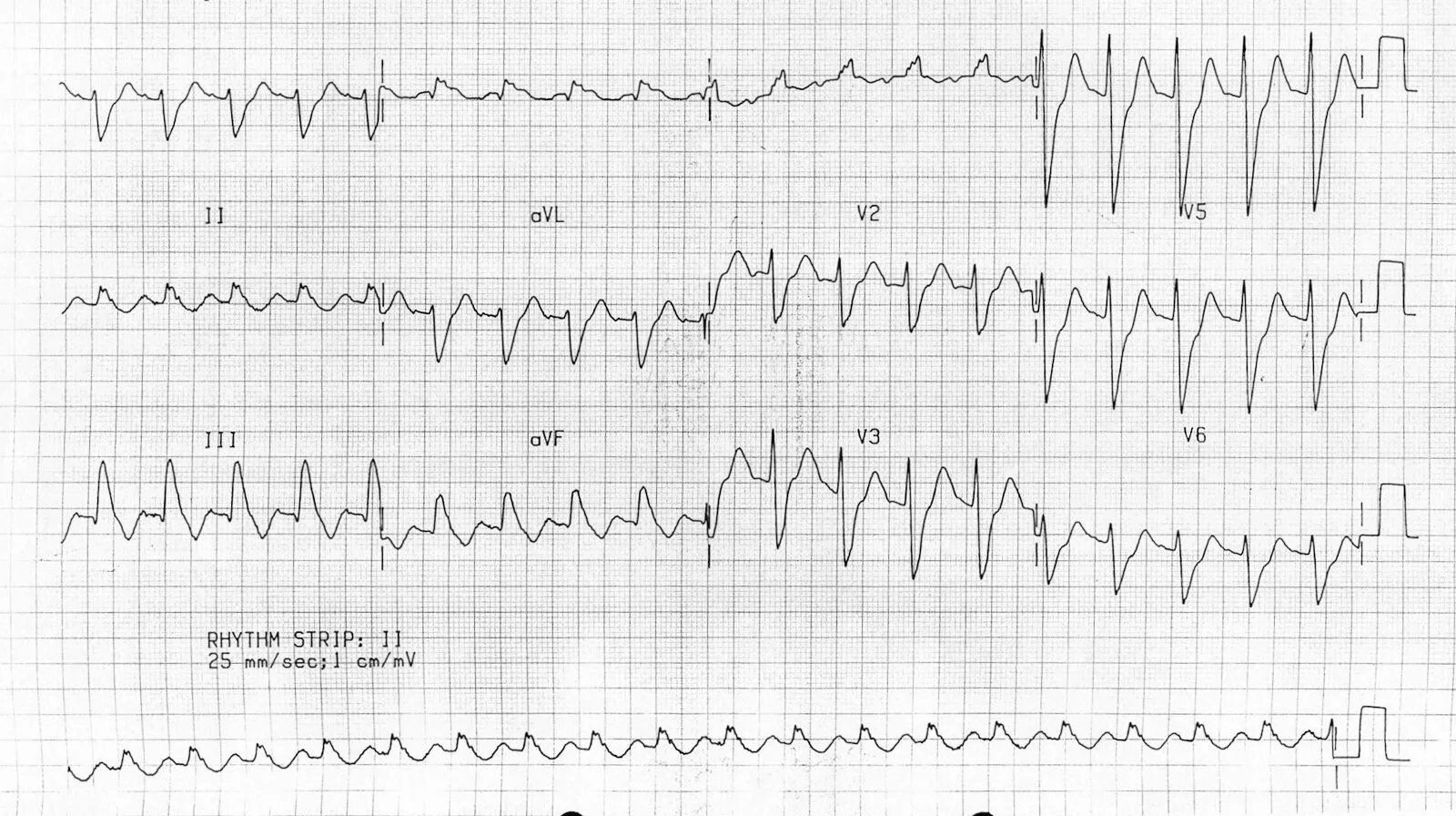 Экг подъем. S1 q3 на ЭКГ. Подъем сегмента St в AVR. Поражение левой коронарной артерии на ЭКГ. Бигинемия на ЭКГ.