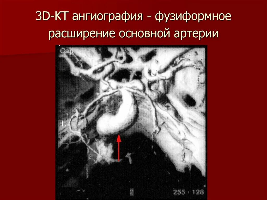 Фузиформное расширение основной артерии. Фузиформное расширение внутренней сонной артерии кт. Фузиформные аневризмы. Фузиформная аневризма головного мозга.