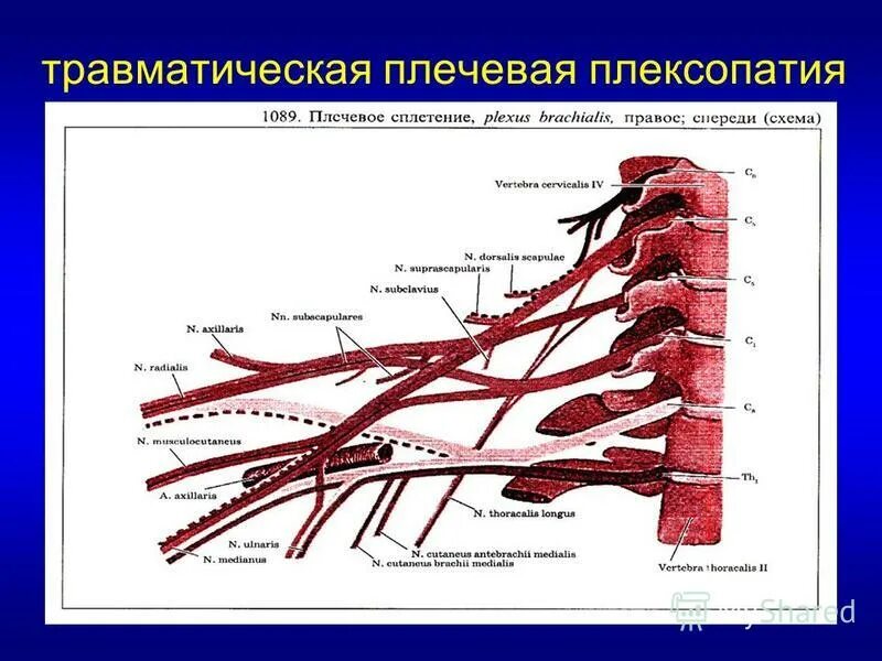 плексопатия плечевого сплетения симптомы. плексит неврит плечевого нерва. плексит плечевого сплетения. плексопатия плечевого сплетения.