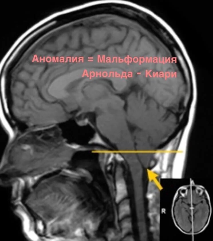Синдром арнольда. Мальформация киари радиография. сирингомиелия арнольда киари. арнольда киари после операции мрт. синдром арнольда-киари мкб 10.