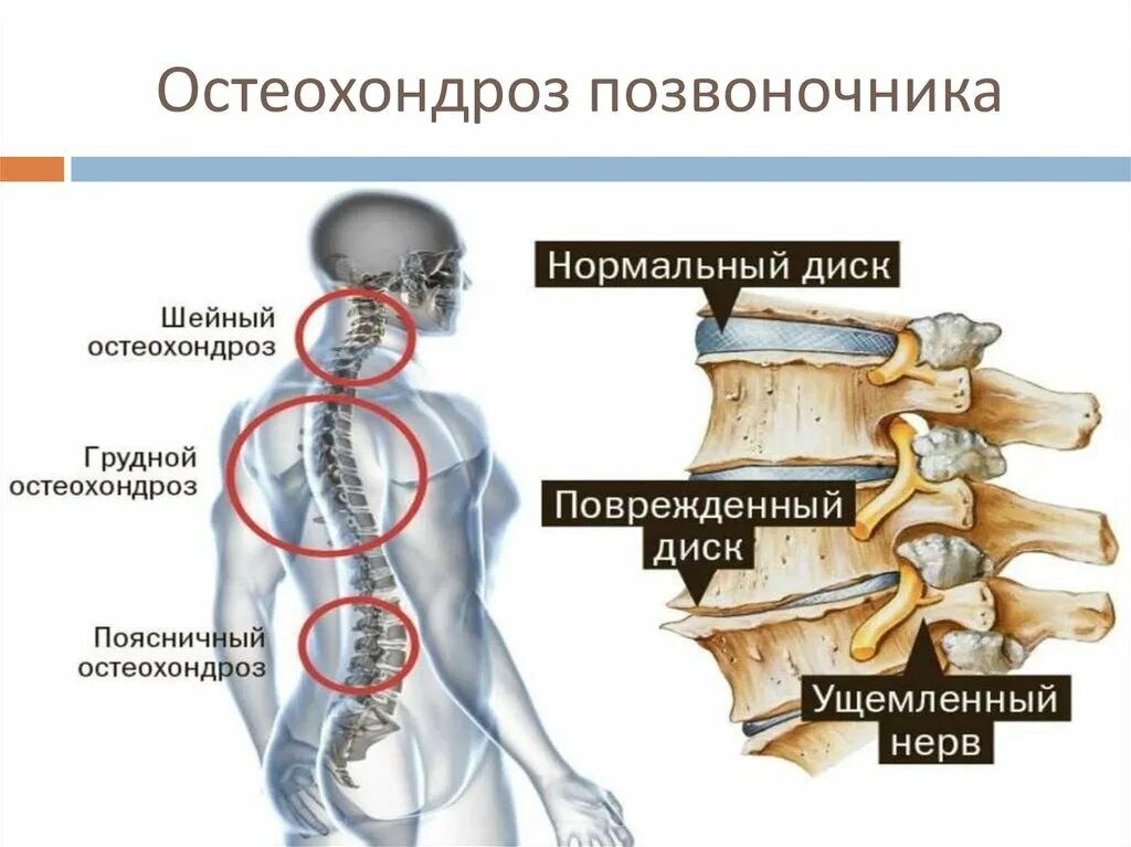 Радикулопатия пояснично-крестцового отдела позвоночника. Радикулит шейного отдела позвоночника симптомы. Остеохондроз позвоночника. Шейный и поясничный отдел позвоночника.