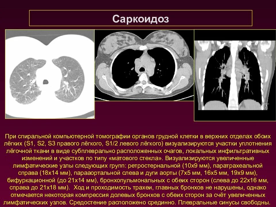 Субплевральные отделы легких. Легочно-медиастинальная форма саркоидоза легких кт. Саркоидоз кт картина.