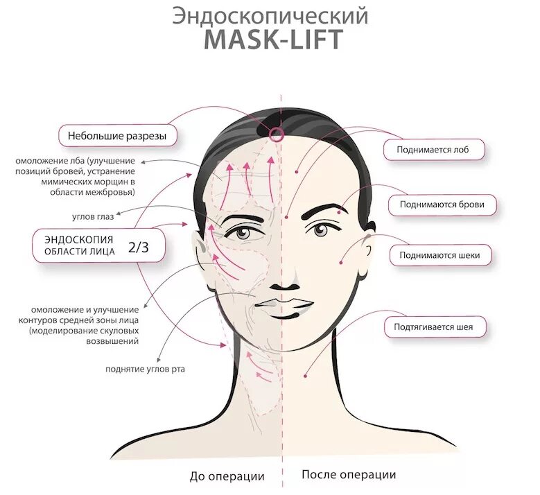 Схема подтяжки лица. Эндоскопическая подтяжка средней.зоны лица схема. Схема проведения смас лифтинга лица. РФ лифтинг лица схема. Эндоскопический височный лифтинг схема.