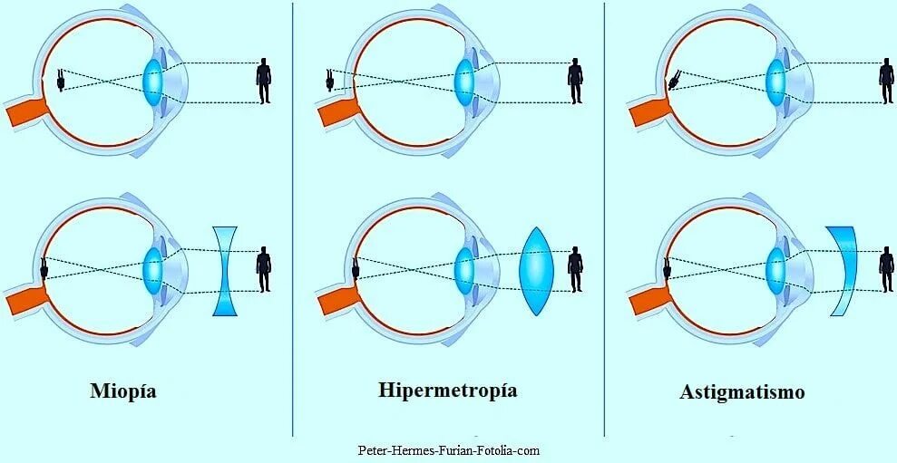 Линзы при миопии и гиперметропии. Очки ( схемы : близорукость и дальнозоркость). Линзы форма для дальнозорких и близоруких. Близорукость и дальнозоркость линзы. Какое зрение при дальнозоркости