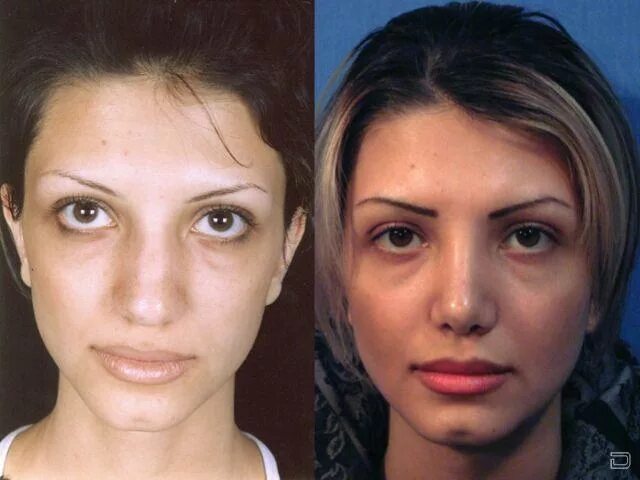 Ринопластика фото до и после операции Rhinoplasty Before and After photos #SanDiego #Nosejob Rhinoplasty before and af