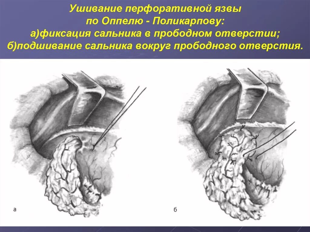 Ушивание прободной язвы по опелю Поликарпову. Ушивание прободной язвы желудка по Поликарпову. Ушивание перфорации по Оппелю Поликарпову. Операция Оппеля Поликарпова. Хирургическое лечение язвы