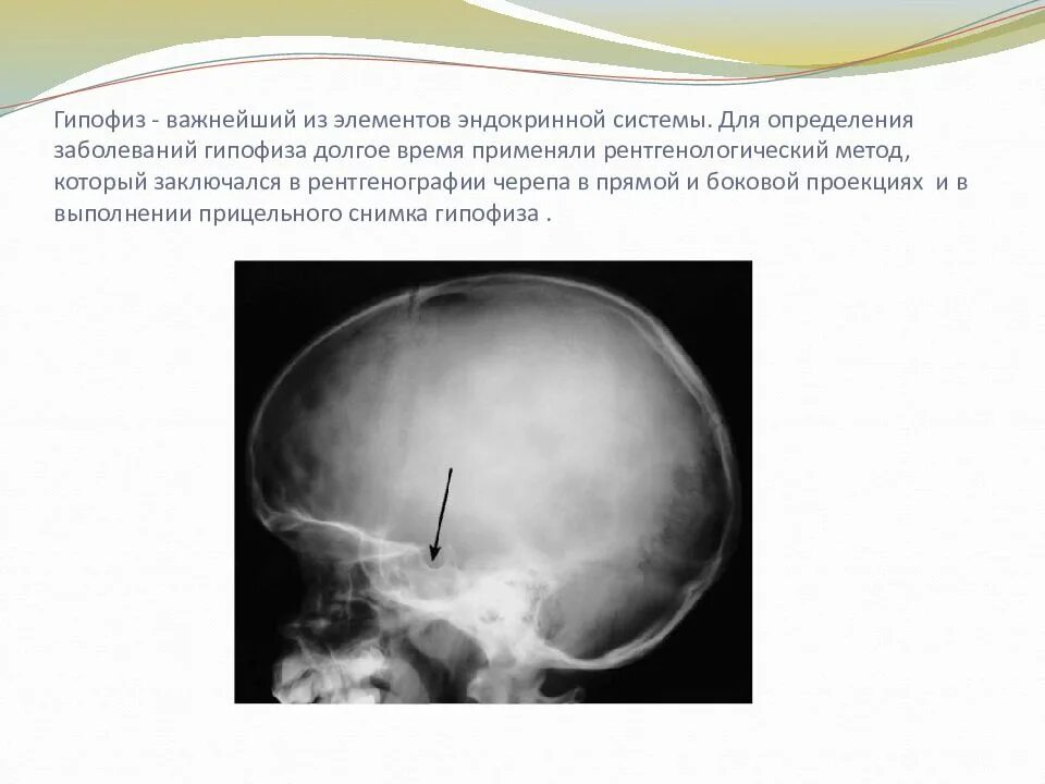 Нарушения работы гипофиза заболевания. Рентген турецкого седла при аденоме гипофиза. Аденома гипофиза патология. Рентген турецкого седла опухоль гипофиза. Рентгенограмма турецкого седла.
