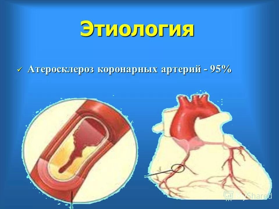 Атеросклероз этиология