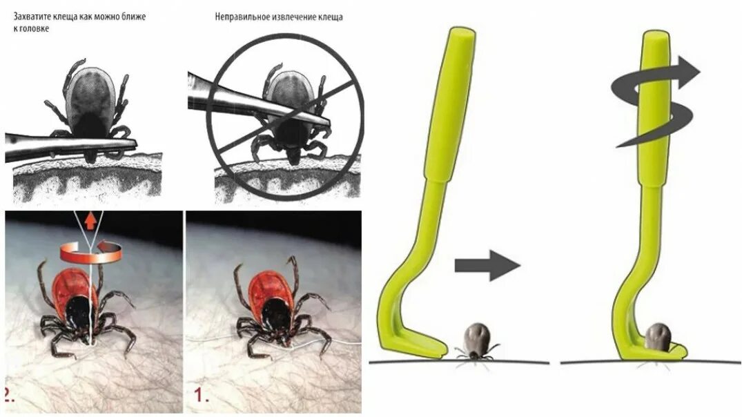 Удалить клеща в домашних условиях у человека. Как достать клеща у человека пинцетом. Как правильно извлечь клеща. Извлечение клеща с помощью шприца. Как удалить клеща пинцетом.