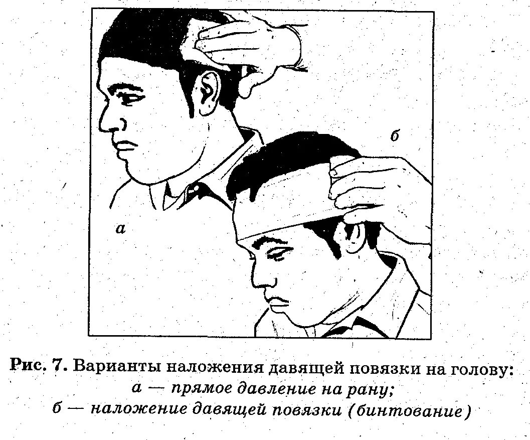 Повязка накладывается при повреждении затылка. Первая помощь при ранении в голову наложение повязки. Давящая повязка на голову. Способы остановки кровотечения при ранении головы. Наложение давящей повязки на голову.