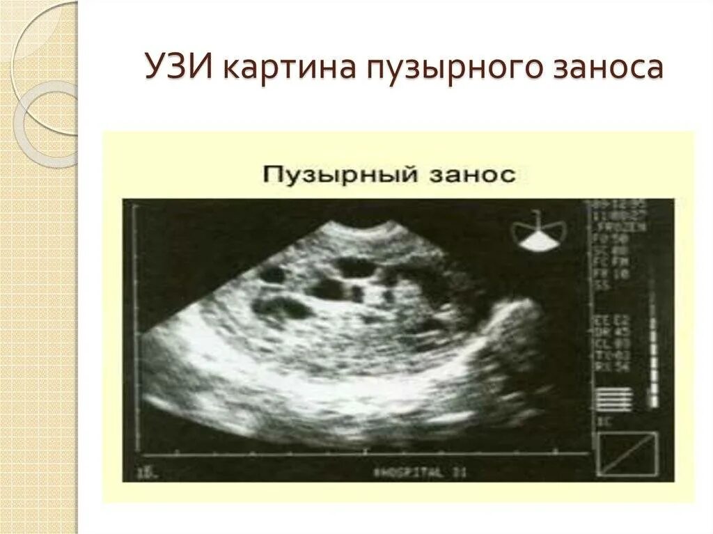 пузырный занос на ранних сроках