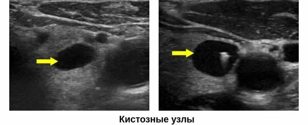 Коллоидная киста щитовидной железы на узи. Диффузные изменения щитовидной железы протокол узи. Диффузные изменения щитовидной железы кисты. Кистозные образования в щитовидной железе по узи. Кистозный узел щитовидной железы на узи.