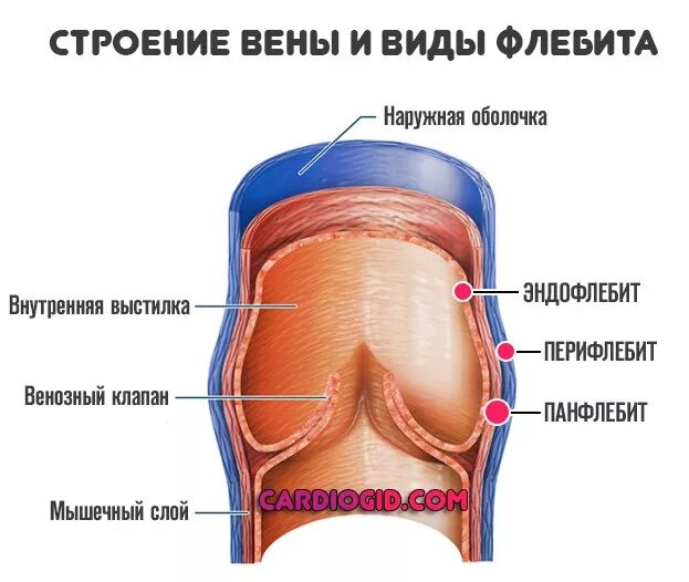 Воспаление внутренней оболочки вены латынь. Воспаление вен нижних конечностей. Флебит вен нижних конечностей. Флебит – воспаление вены.