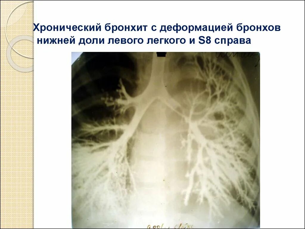 Подозрения на бронхит. Хроническое воспаление бронхов.