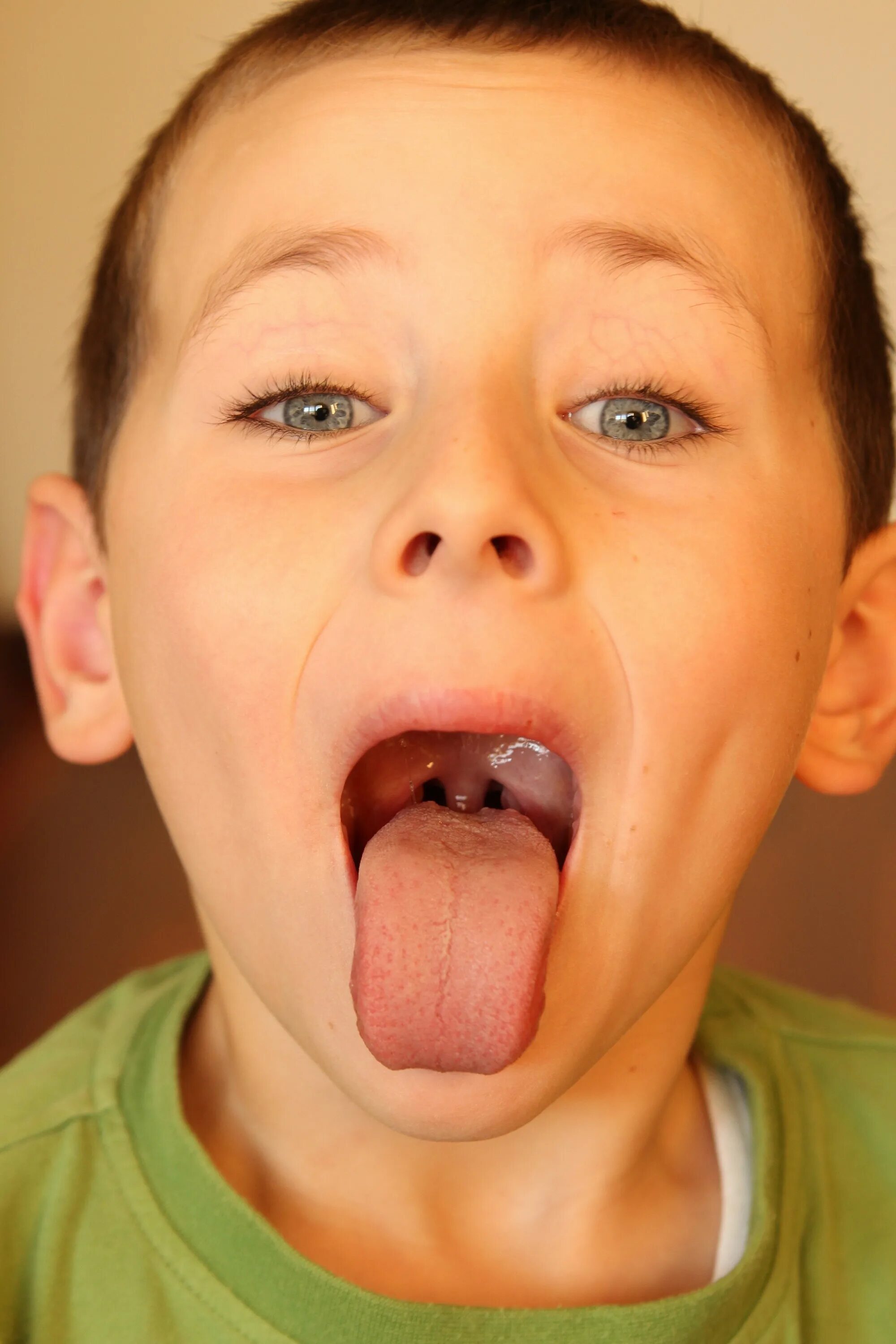 анатомия лор органов аденоиды. строение носоглотки аденоиды. как снять воспаление аденоидов. фарингоскопия фарингит. глоточная миндалина аденоиды.