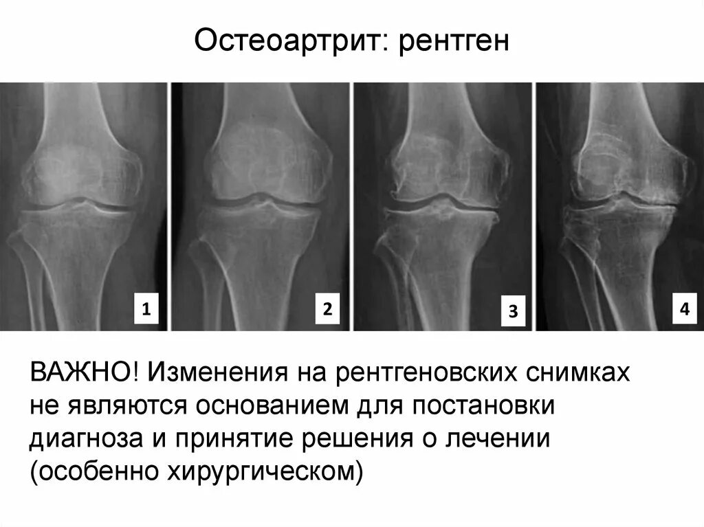 Коленный сустав по стадиям. Артрит коленного сустава рентген. Остеоартрит коленного сустава рентген. Остеоартроз коленного сустава 2 степени рентген. Деформирующий артроз коленного сустава рентген степени.