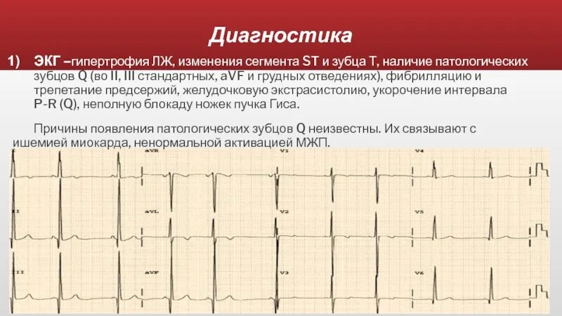 Изменение зубца q. Зубец q II III AVF. Патологический зубец q в грудных отведениях. Патологические зубцы q в II, III, AVF.. Патологический зубец q в 2 3 AVF.