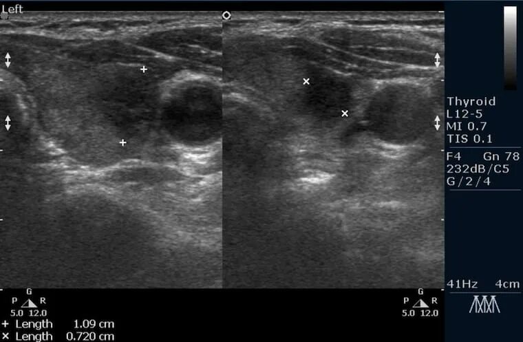 Метастазы щитовидной железы на УЗИ. Лимфоузел в щитовидной железе на УЗИ. Лимфатический узел щитовидной железы УЗИ. Метастазы в щитовидной железе на УЗИ. Метастатические лимфоузлы