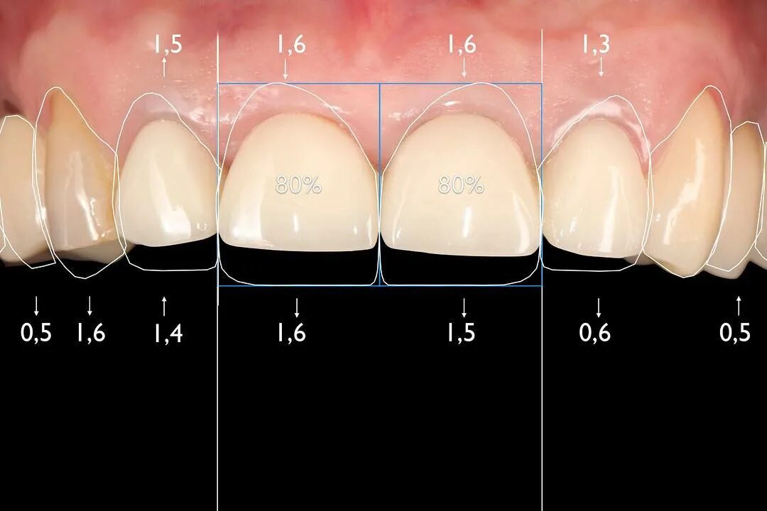 Se pueden limar los dientes de largo