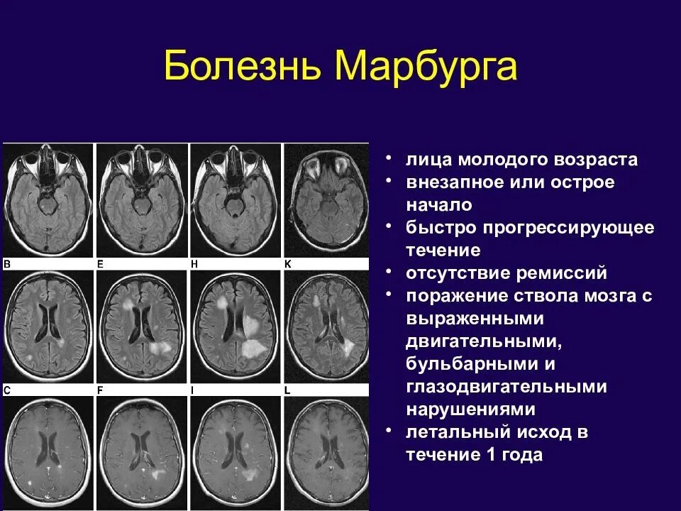 Склероз мозга. Марбурга демиелинизация. Рассеянный склероз Марбурга.