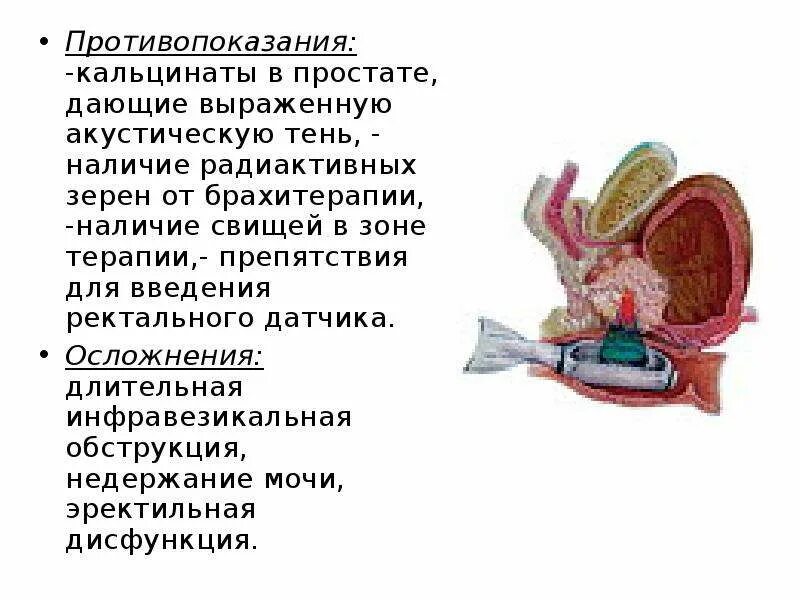 Почему после удаления простаты. Парауретральные кальцинаты. Кальцинат предстательной железы. Камни в предстательной железе. Кальцинат в предстательной железе.