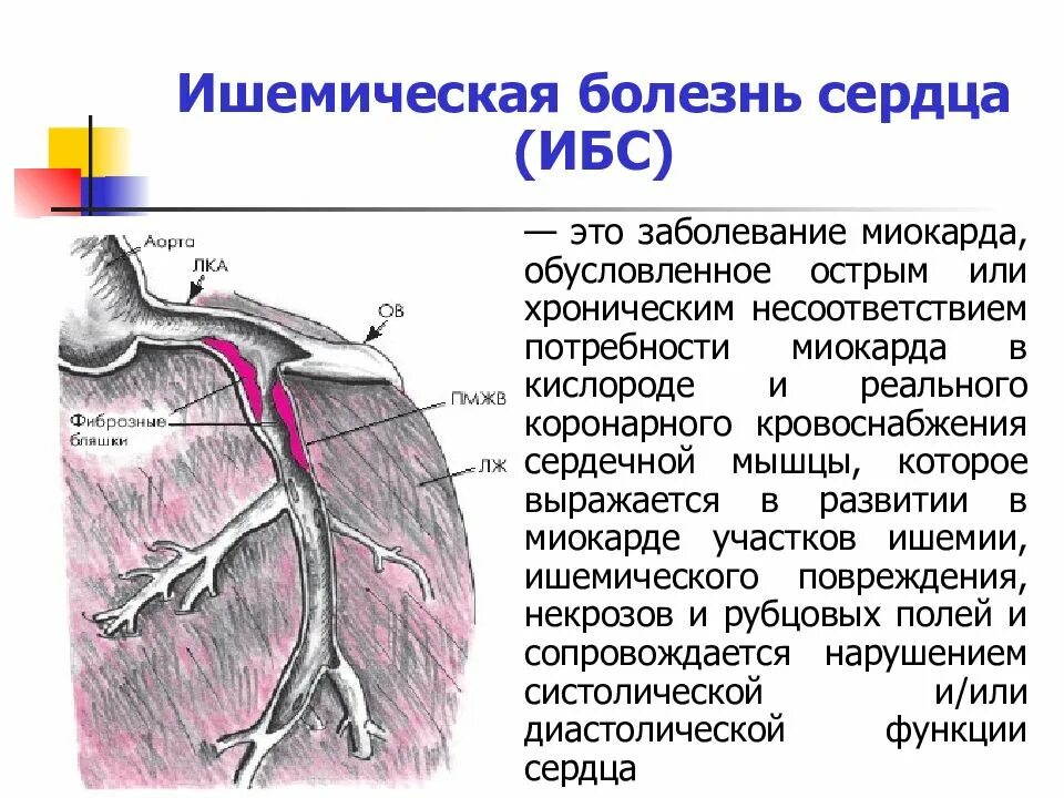 Ишемия боковой стенки. ИБС заболевания сердца. Ишемическая (коронарная) болезнь сердца (ИБС).