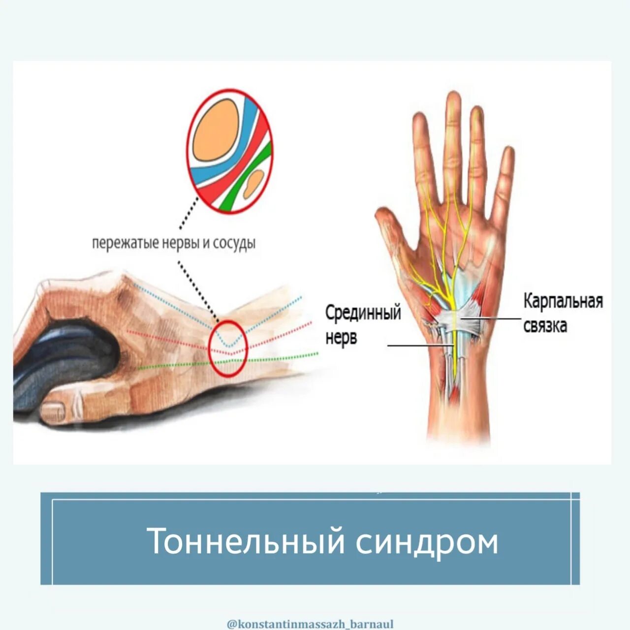 Операция карпального канала кисти. Туннельный синдром срединного нерва. Карпальный туннельный. Карпальный канал лучезапястного сустава. Синдром запястного канала (карпальный туннельный синдром).