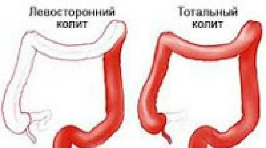 Хронический колит симптомы лечение у женщин. Хронический неспецифический колит. Тотальный кишечный колит. Правосторонний язвенный колит кишечника. Язвенный колит толстой кишки.