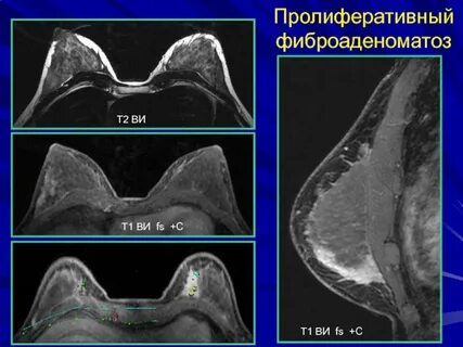 Смешанный фиброаденоматоз