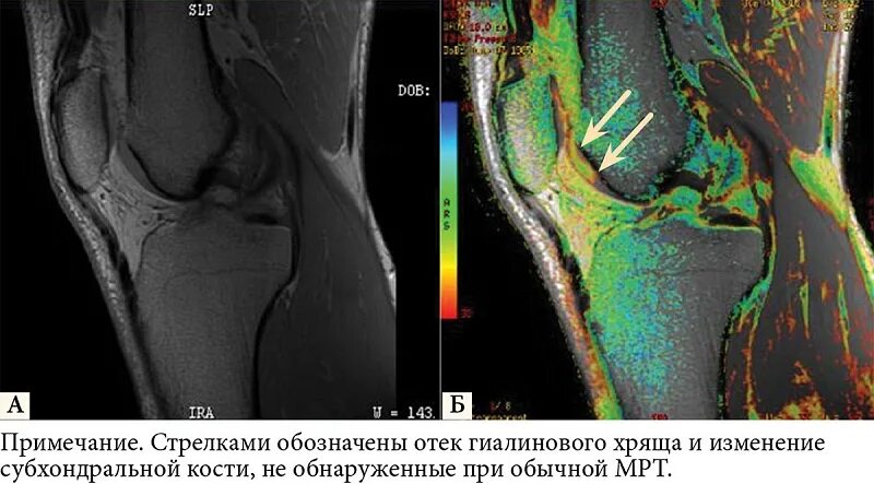 Артрит кт. Ревматоидный артрит коленного сустава мрт. Артрит коленного сустава мрт. Картирование хряща коленного сустава. Ревматоидный артрит мрт колена.