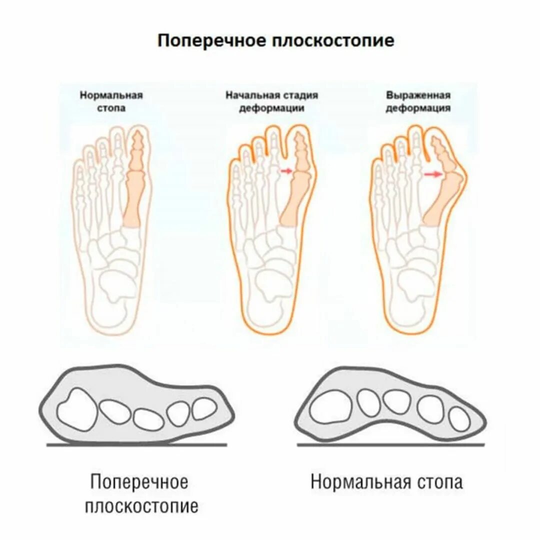 симптомы продольного и поперечного плоскостопия. продольное и поперечное плоскостопие. продольный свод стопы плоскостопие. поперечное плоскостопие клинические рекомендации. продольное поперечное и комбинированное плоскостопие.