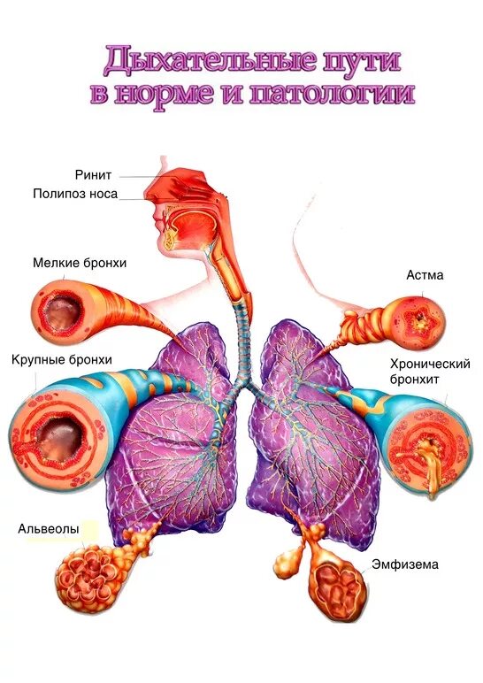 Патологии дыхательных путей. Бронхиальная астма дыхательная система. Патологии дыхательной системы. Дыхательная система и астма. Обструкция дыхательных путей бронхиальная астма.