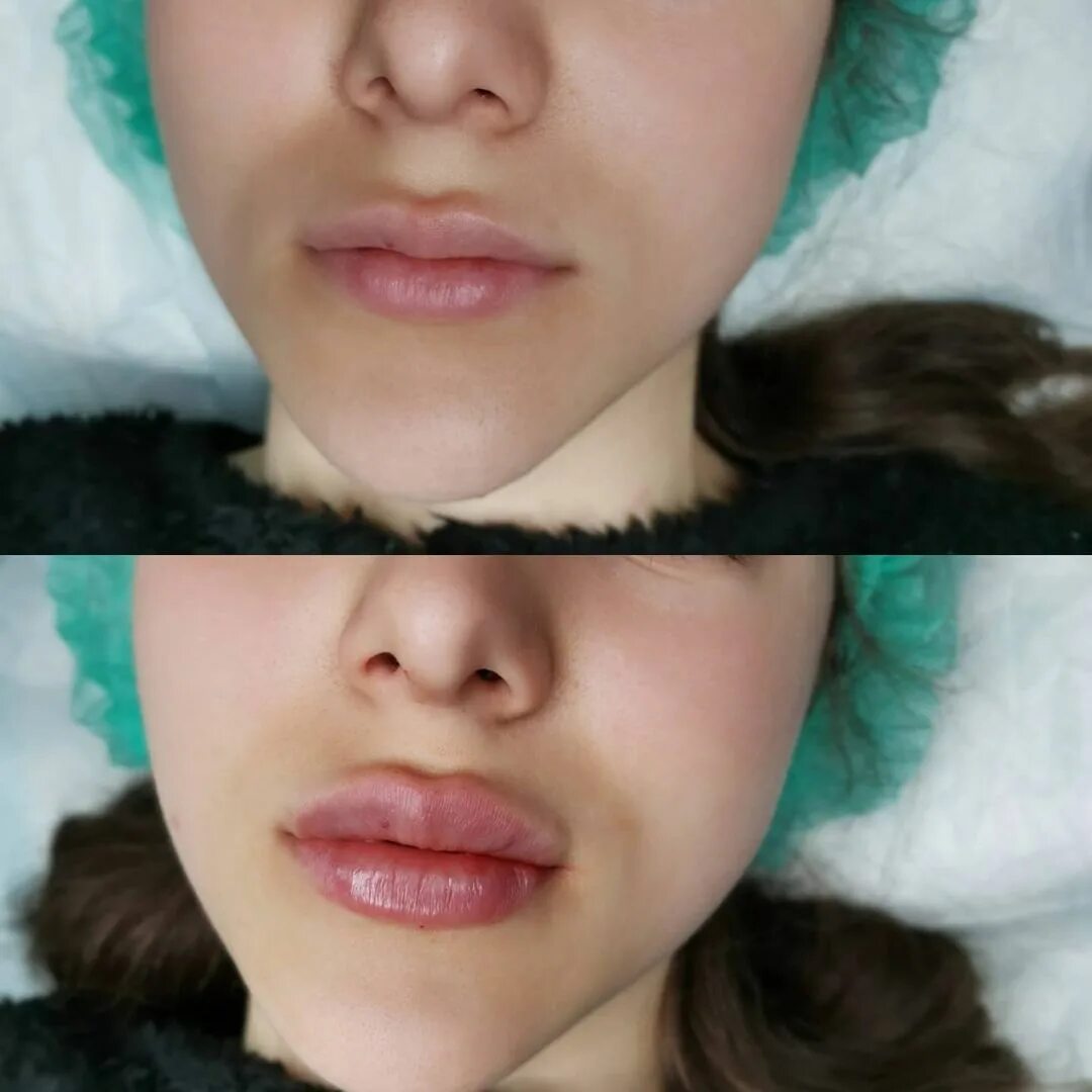 увлажнение губ гиалуроновой кислотой. коррекция губ гиалуроновой кислотой 1 мл. инъекции гиалуроновой кислоты. увеличенные губы красивые. операция миро хейлопластика.