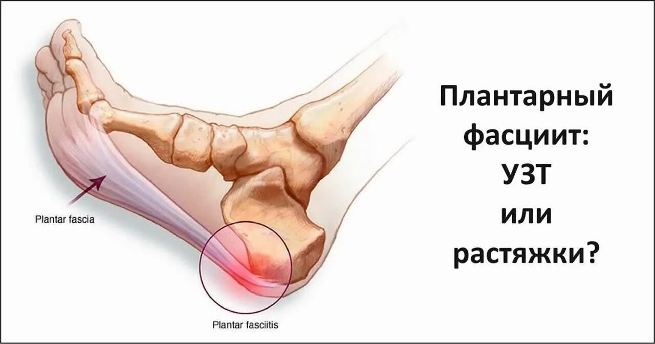 Фасцит в пятке. Боль в пятке плантарный фасциит. Пяточная шпора плантарный фасциит. Плантарный фасциит стопы магнитотерапия. Плантарный фасциит лечебная гимнастика.