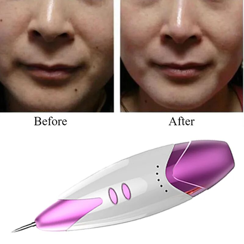 ручка для удаления татуировок папиллом бородавок beauty star. как удалять папилломы лазерной ручкой правильно. лазерная плазменная ручка для удаления папиллом. удаление папиллом коагулятором ручкой. как удалять папилломы лазерной ручкой правильно.