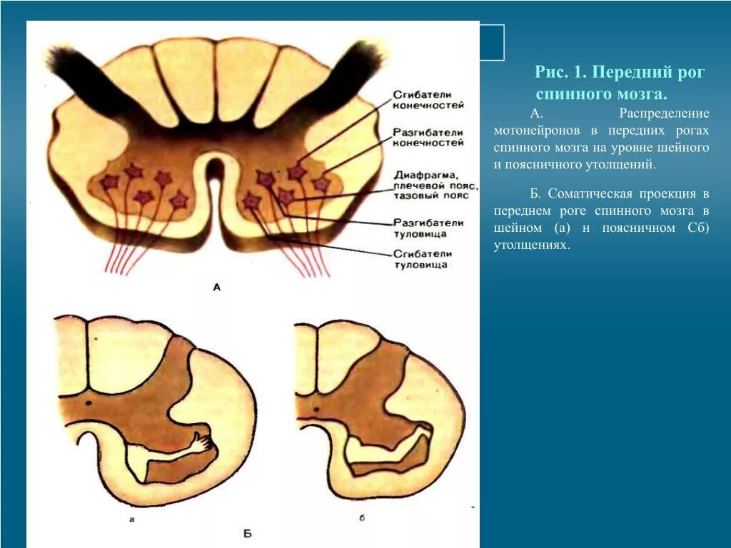 Поражение передних рогов. Поражение передних Рогов спинного мозга на поясничном уровне. Передний Рог. Передний Рог спинного мозга. Передних Рогов спинного мозга.