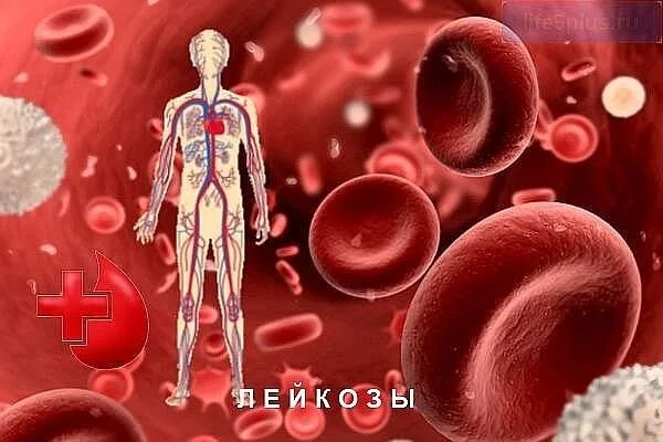 Лейкемическая форма. Вика лейкоз. Вика лейкоз. Клетки лейкоза. Лейкоз начальная стадия симптомы.