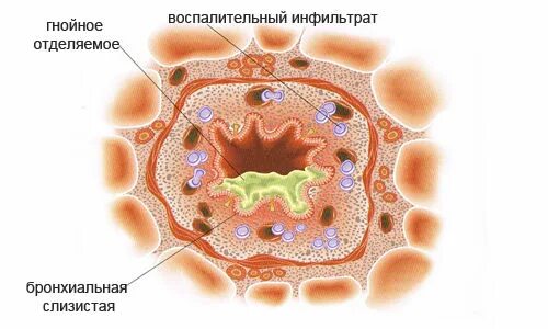 Бронхи гной. Бронхи гной. Бронхи гной. Острое воспаление слизистой оболочки бронхов. Гнойно слизистый бронхит симптомы.