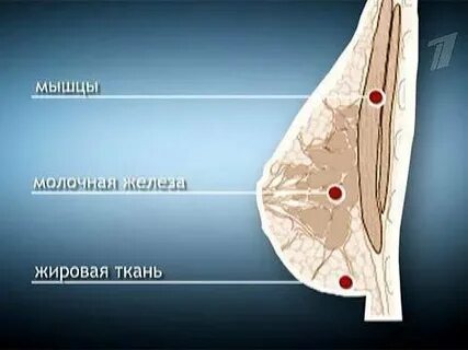 Разрыв импланта