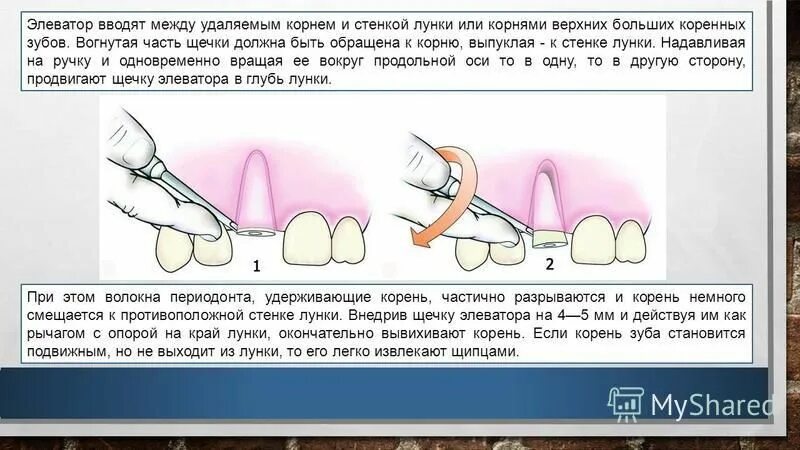 После удаления зуба можно ли пить воду. Как удаляют зуб элеватором. Неудаленные корни зуба.