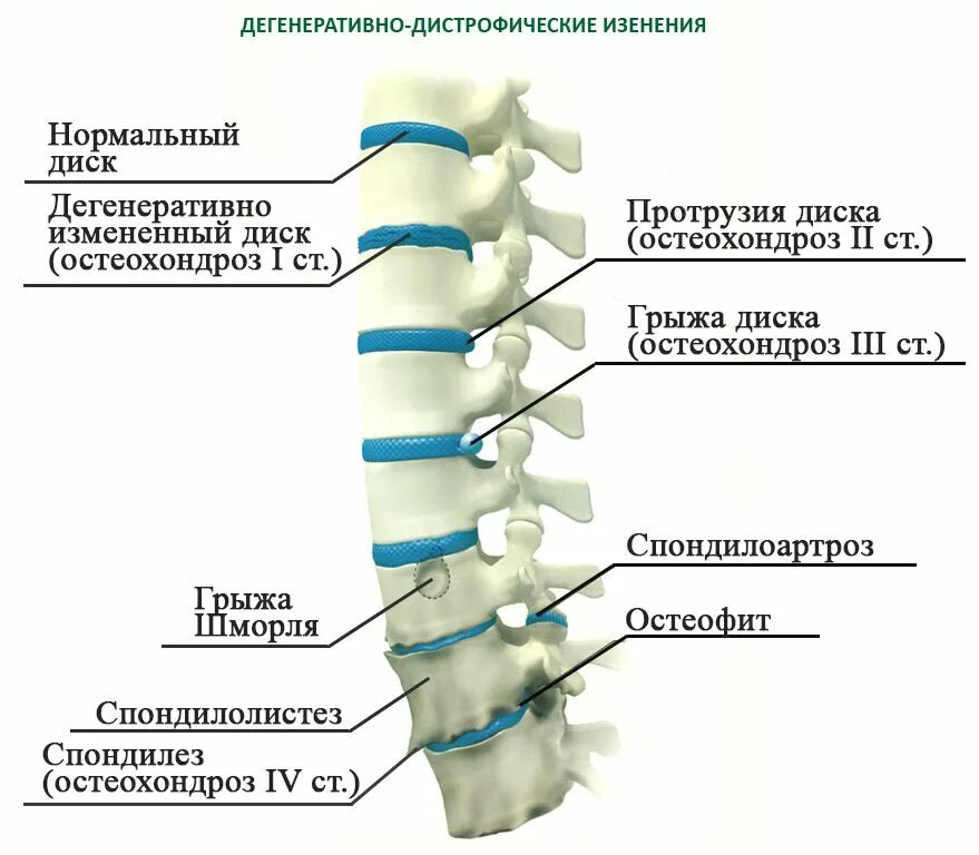 Диффузно дегенеративные. Протрузии дисков c4/c5 c5/c6 c6/c7. Протрузия диска l1 l2, l2-l3. L2-l3 l3-l4 межпозвонковые диски. Протрузия диска th1/th2.