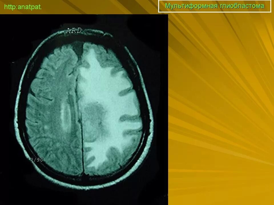 Глиобластома головного мозга. Мультиформная глиобластома осложнения. Симптомы глиобластомы головного