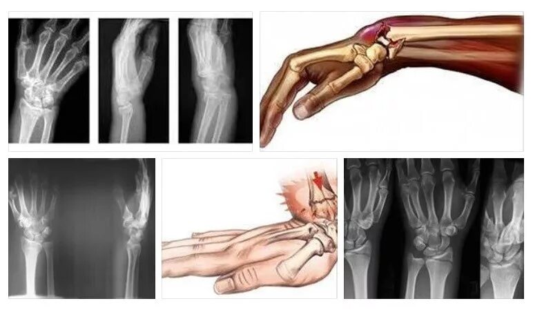 Смещение кости на руке без перелома. Перелом дистального метаэпифиза лучевой кости. Перелом диафиза лучевой кости гипс. Перелом лучевой запястной кости. Перелом н/3 лучевой кости со смещением.