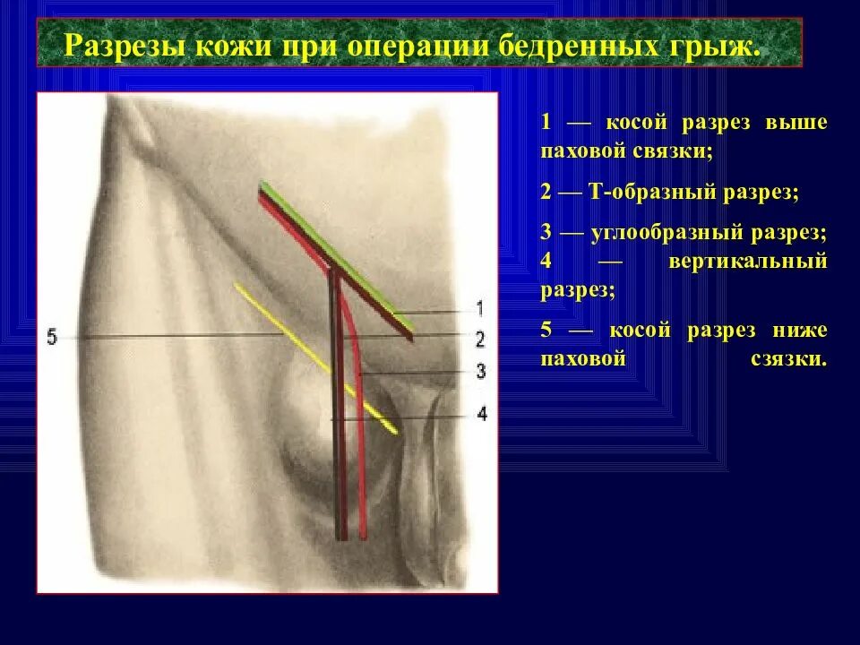 Паховая грыжа методы лечения. Бедренная грыжа спереди покрыта. Бедренная паховая грыжа операция. Разрез при паховой грыже. Операция паховая грыжа швы.