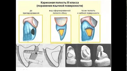 Препарирование кариозных полостей 2 класса по блэку