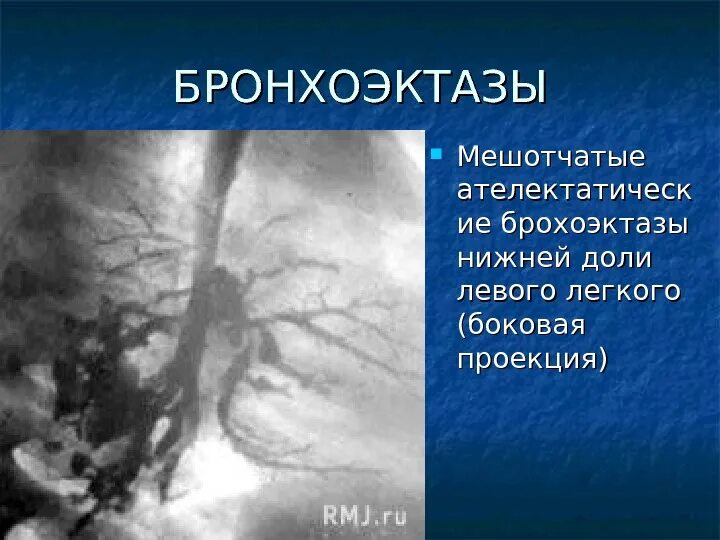 Цилиндрические и мешотчатые бронхоэктазы. Бронхоэктатическая болезнь (бронхоэктазы). Бронхоэктаз правого легкого. Бронхоэктатическая болезнь протокол кт. Цилиндрические и мешотчатые бронхоэктазы.